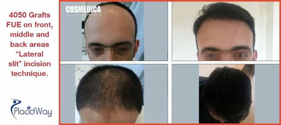 Before and After Images of Hair Transplant in Istanbul, Turkey